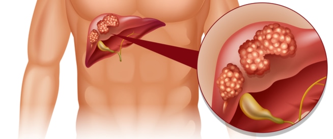 سرطان الكبد