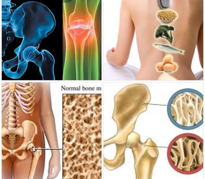 ٧ طرق لمنع هشاشة العظام 