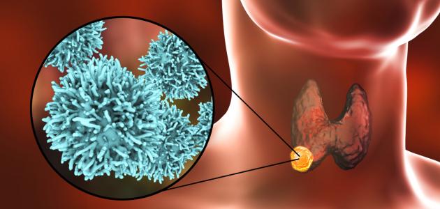 سرطان الغدة الدرقية
