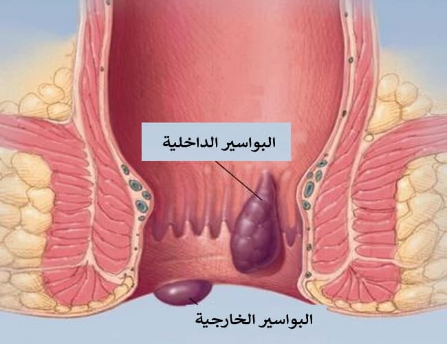 علاج البواسير الداخلية