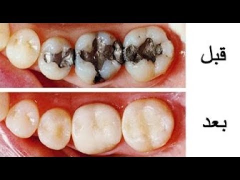 علاج تسوس الاسنان بالاعشاب 