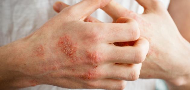 أمراض جلدية خطيرة تصيب مريض السكري