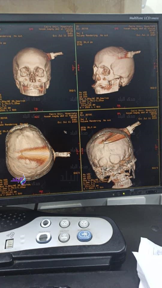 آشعة مقطعية للحالة