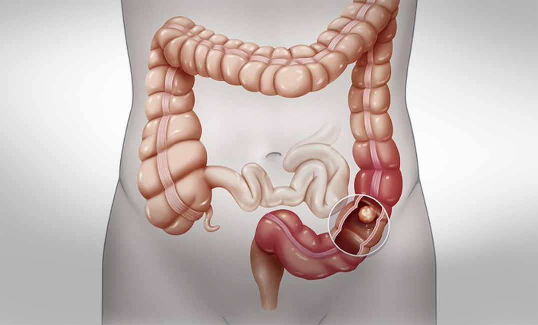 اعراض سرطان الامعاء
