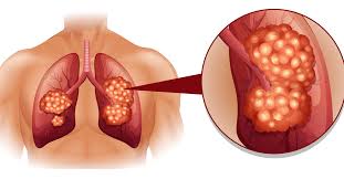 علاج سرطان الرئة
