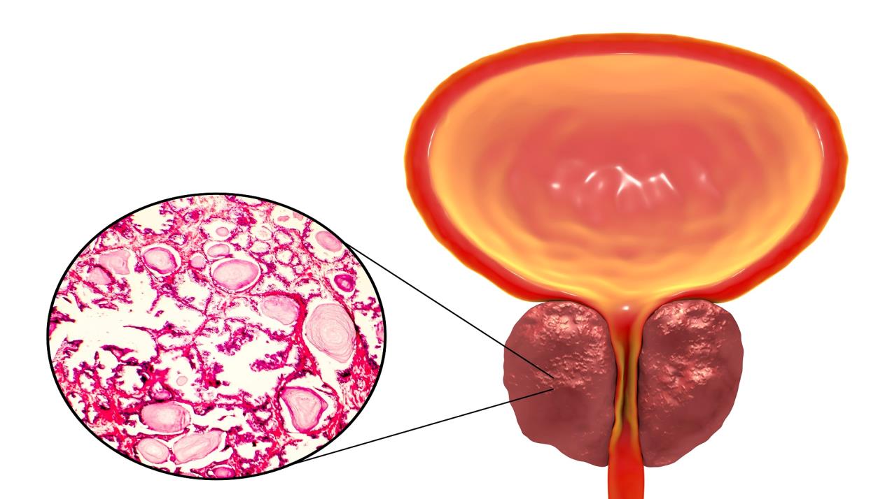 علاج البروستاتا