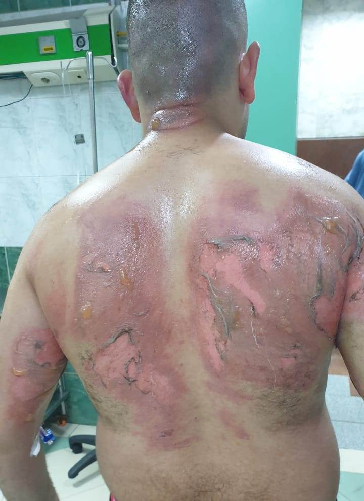 احراق شاب 