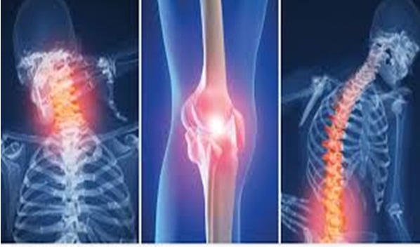 التهاب المفاصل