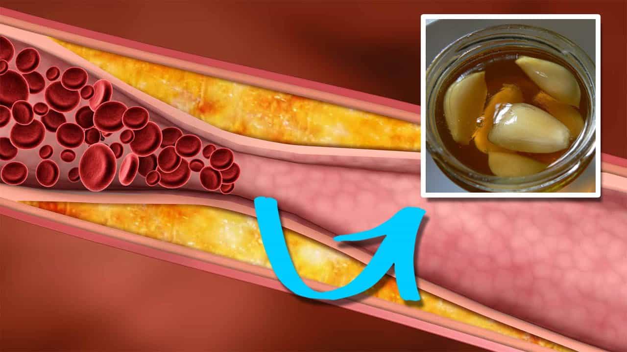 كيف تتخلص من الدهون الثلاثية في الدم 