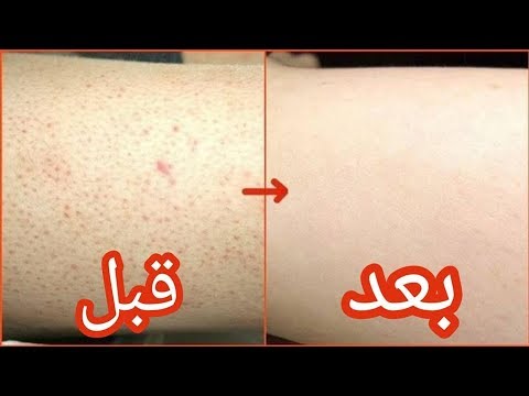 جلد الوزة 