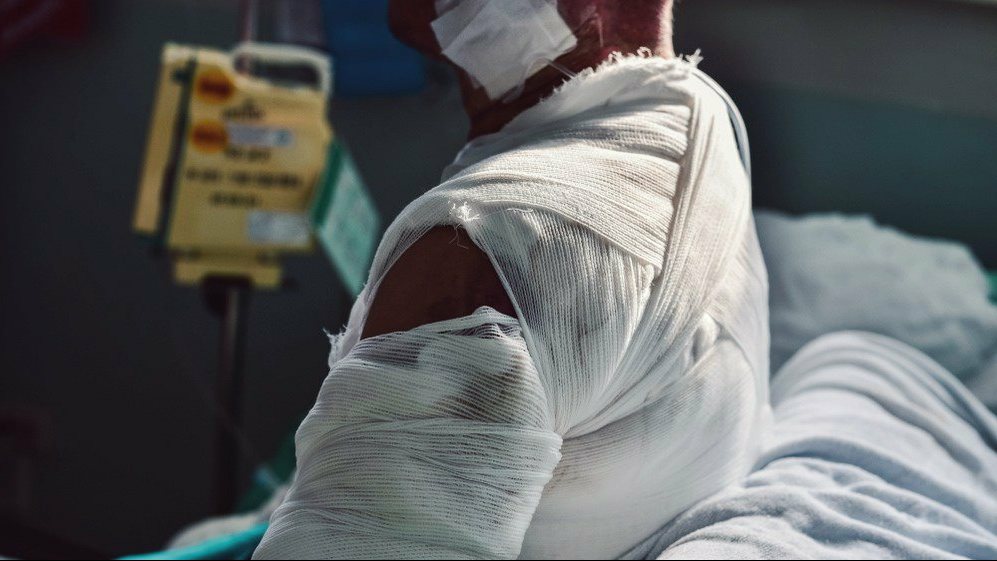 دعم ضحايا الحروق في سيناء