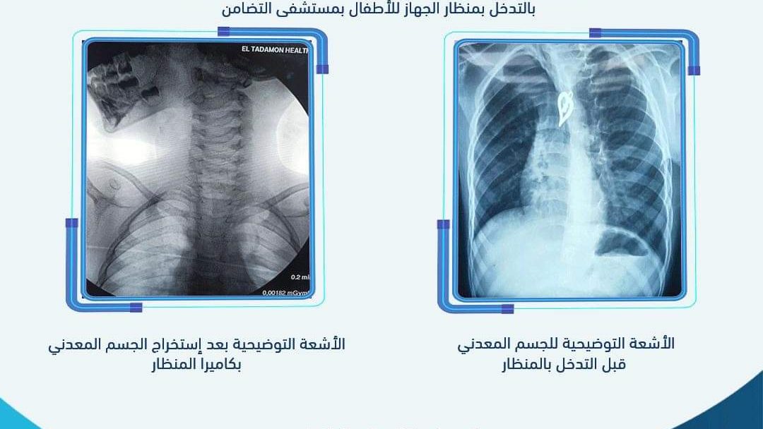 ابتلع دلاية حديدية علقت بالمريئ وانفذ حياته فى تضامن بورسعيد