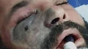 اعراض الفطر الاسود 