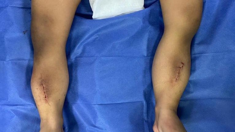 في جراحة نادرة: تقويم اعوجاج ساقي طفلة 6 سنوات بـمستشفي طنطا