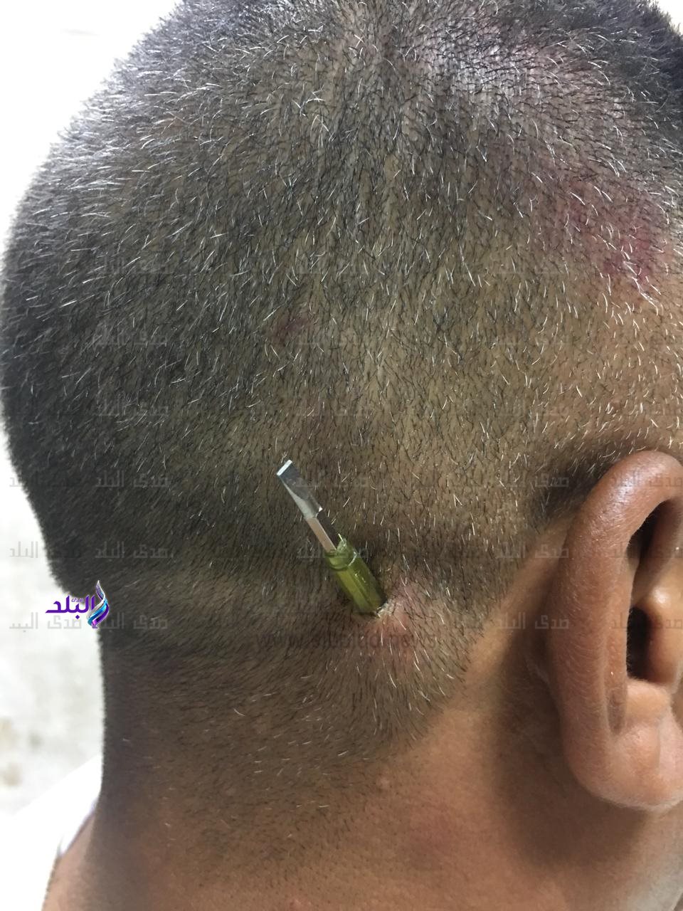 العامل المُصاب بجرح قطعي غائر بالرأس إثر ضربه بمفك