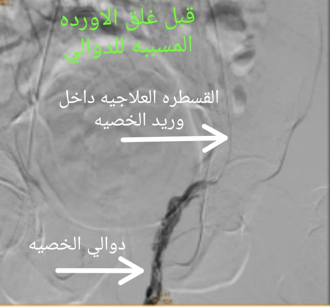 دوالي الخصية