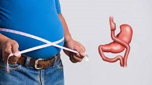 تحويل مسار المعدة