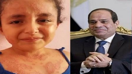 الرئيس السيسي يستجيب لعلاج الطفلة الفلسطينية بيان محمود
