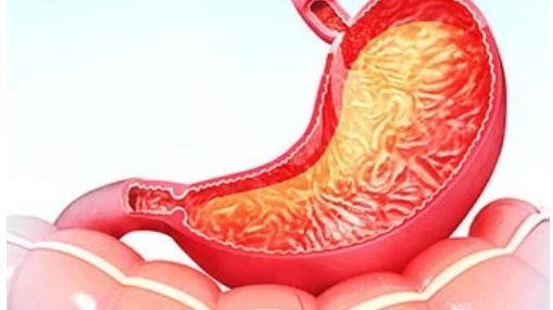 علاج جرثومة المعدة 