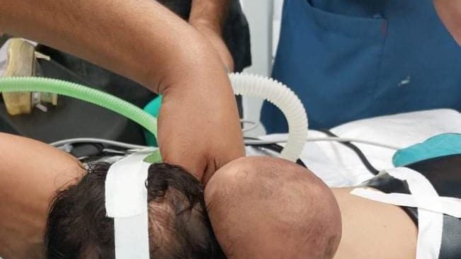 إزالة ورم لطفل رضيع بمستشفى ملوى 