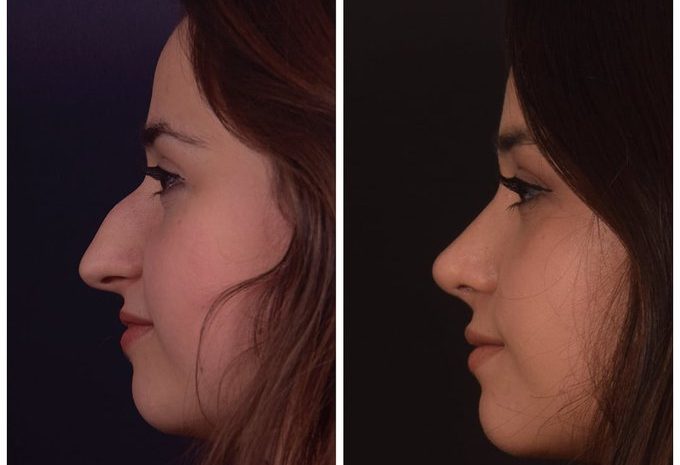 حكم عملية التجميل