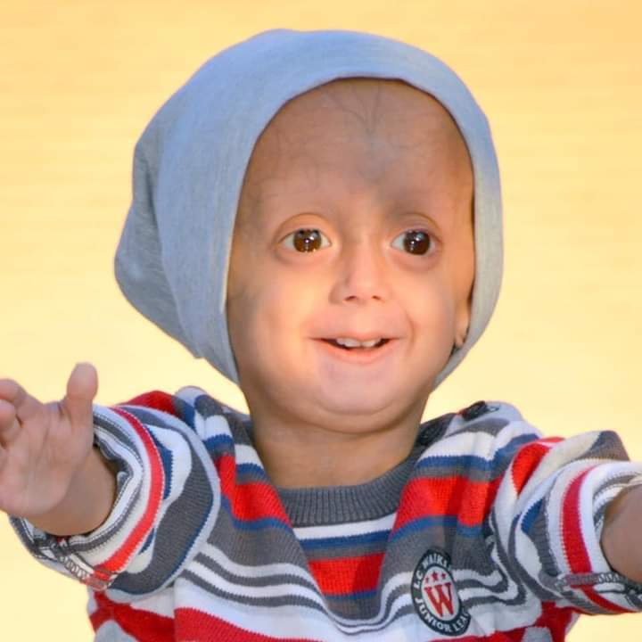 زين الطفل الذي يعاني من شيخوخة مبكرة