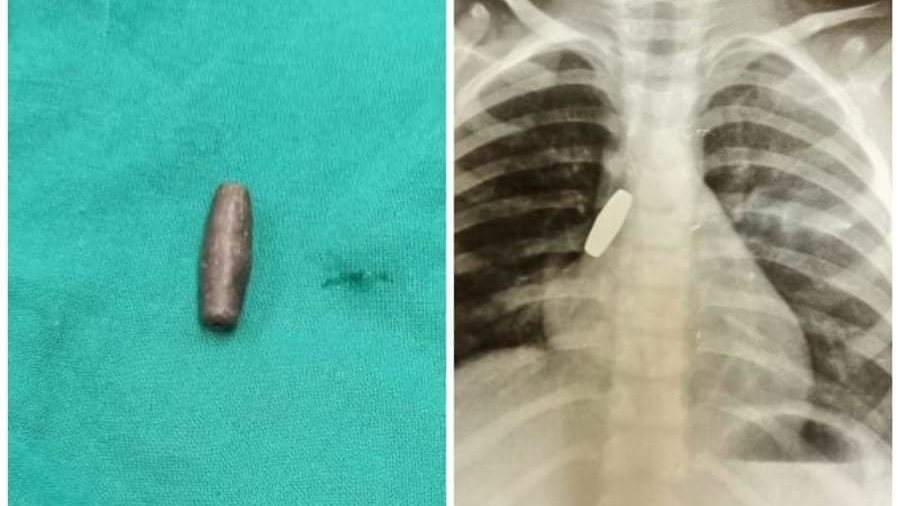 استخراج رصاصه من داخل الشعب الهوائية لطفل