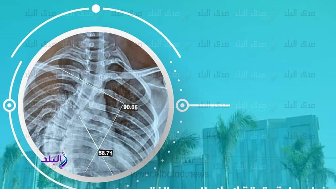 نجاح إجراء عملية تعديل اعوجاج بالعمود الفقري بمستشفي ابو خلي