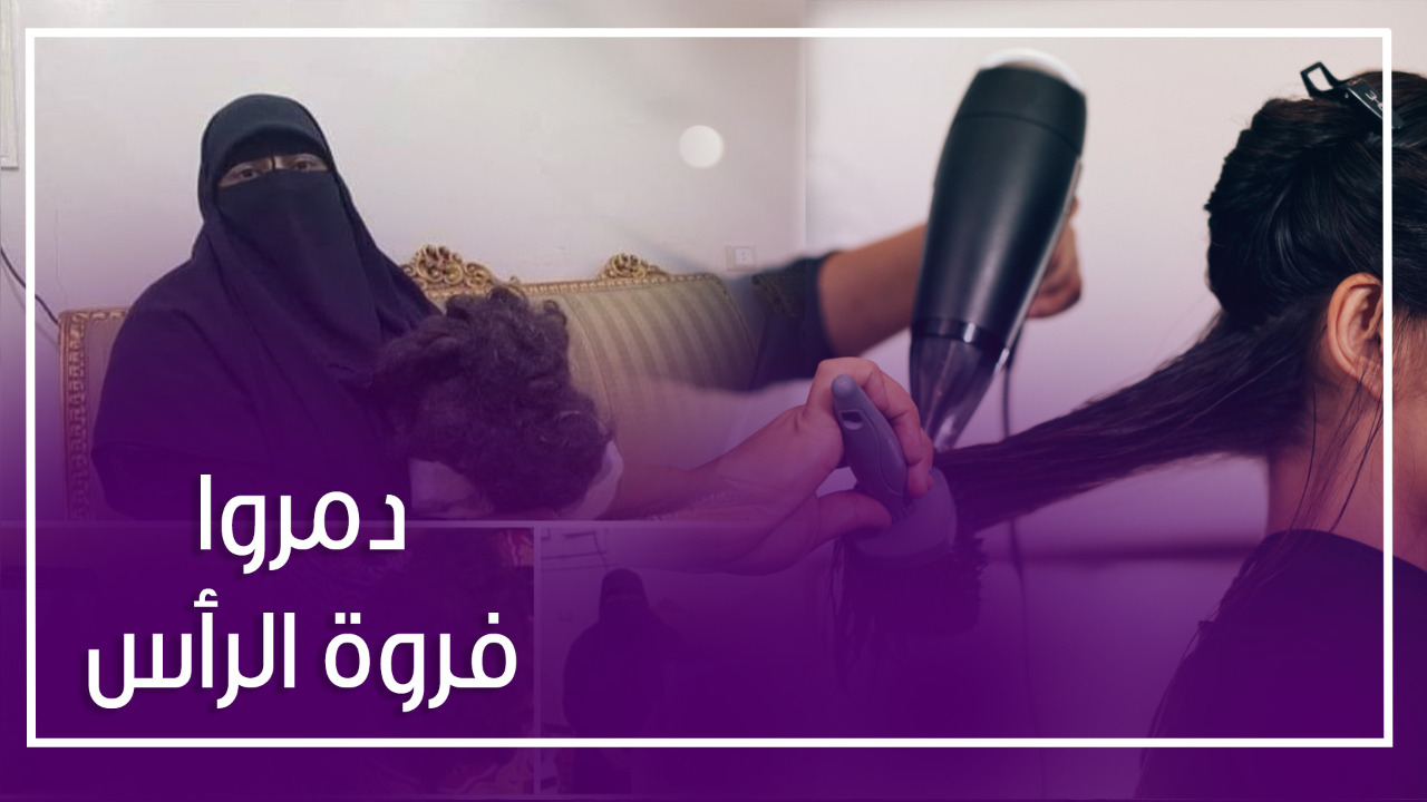 فتاة تصاب بالصلع