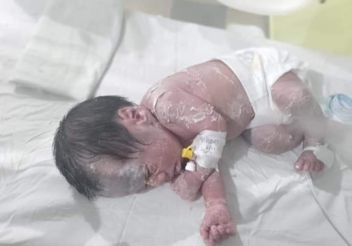 مستشفى عزبه البرج تستقبل حالة نادره لطفل شمعي