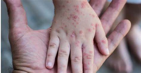 جدري القرود