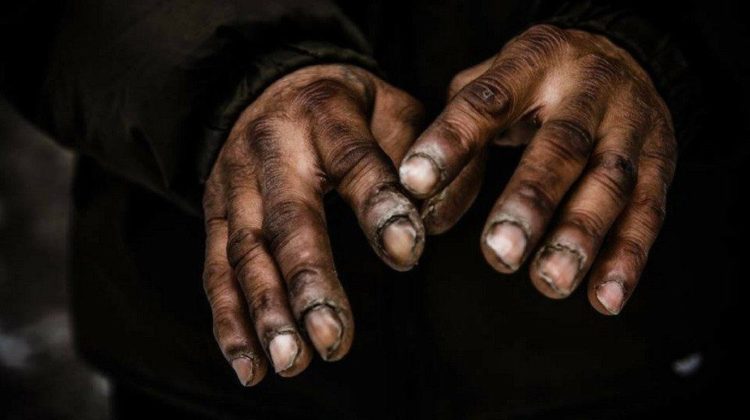 جدري القرود