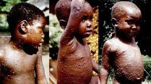 جدري القرود 