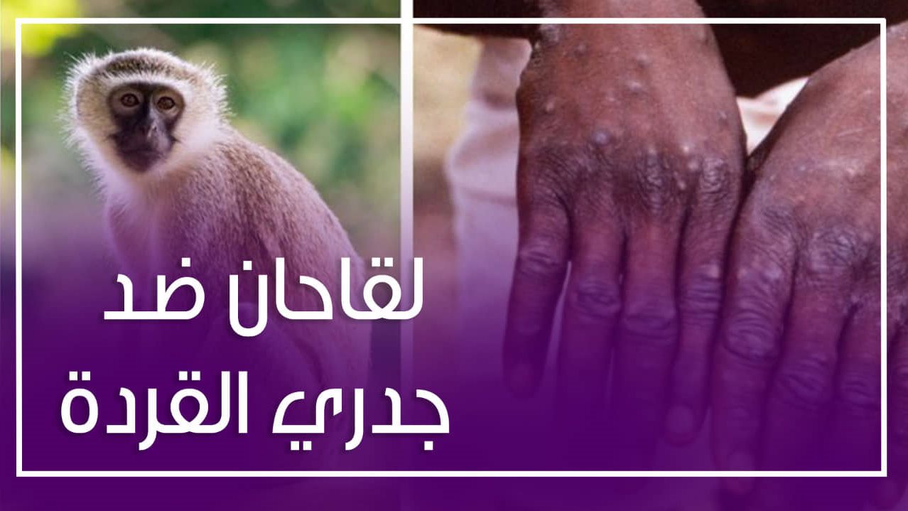 جدري القرود