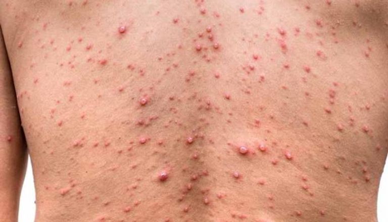 رجال فقط.. ألمانيا تسجل 113 إصابة بجدري القرود 