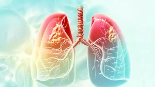 سرطان الرئة