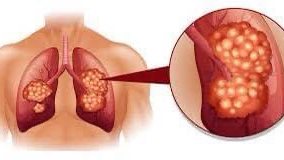 مضاعفات تحدث للمصابين بسرطان الرئة