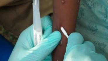 الهند تسجل أول وفاة بفيروس جدري القرود