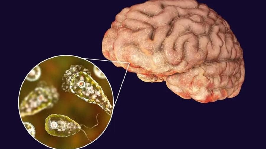 أمريكا.. وفاة شخص بعد إصابته بأميبا آكلة للدماغ