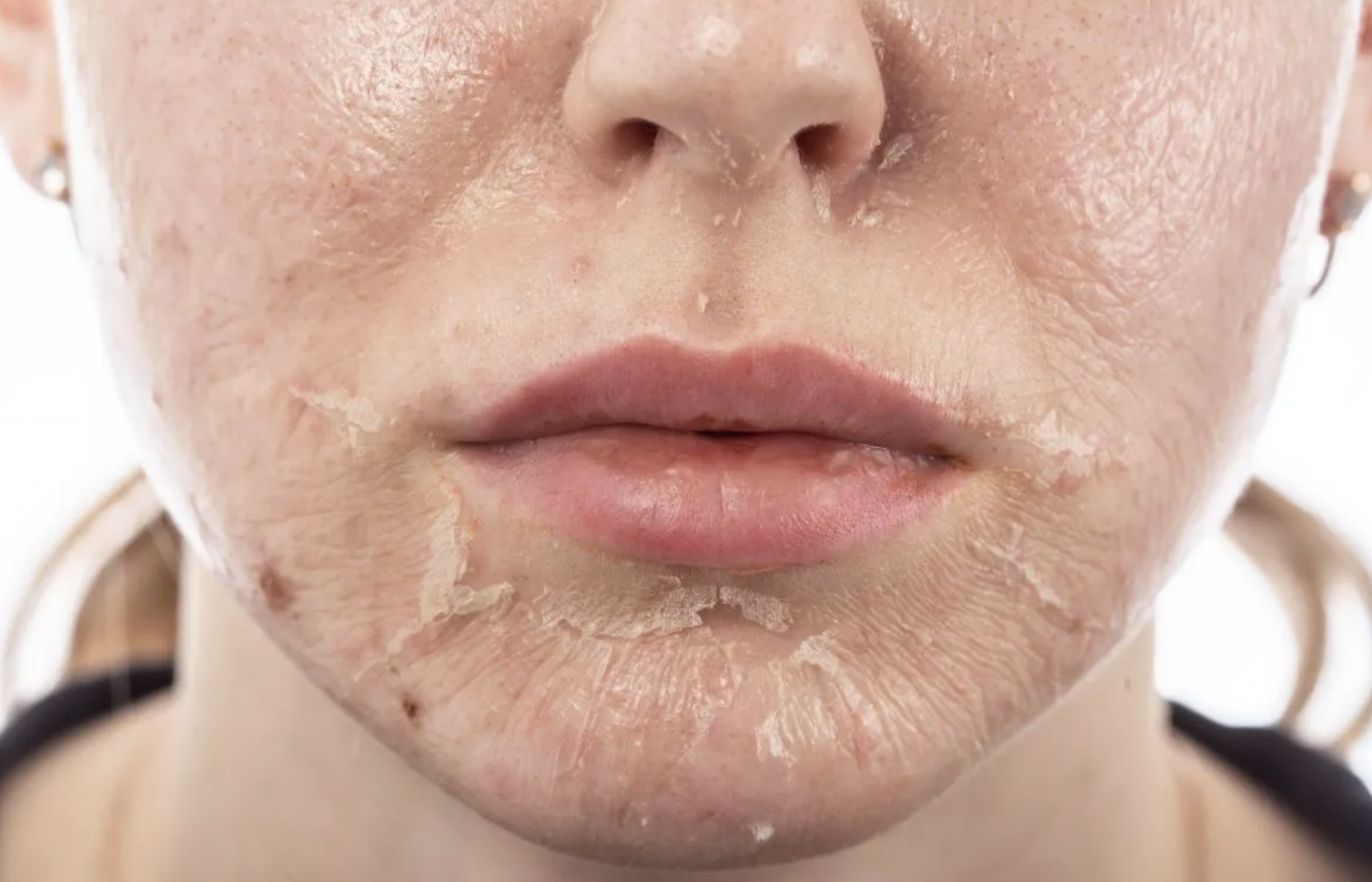 التقشير-الكيميائي-