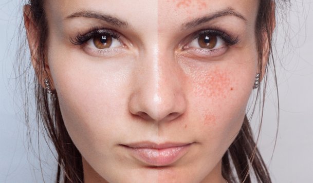 التقشير الكيميائي قبل وبعد 