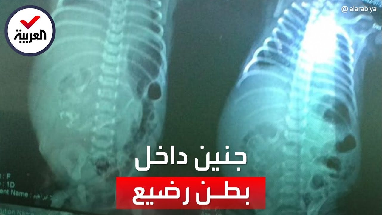 جنين داخل بطن رضيعة