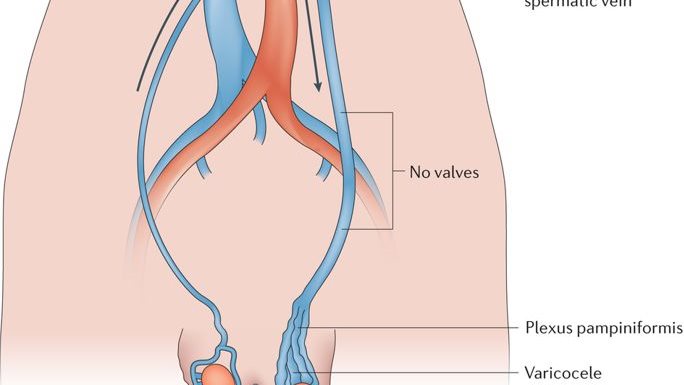 دوالى الخصية 