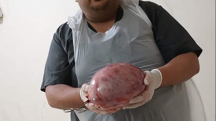 استئصال كيس مبيض