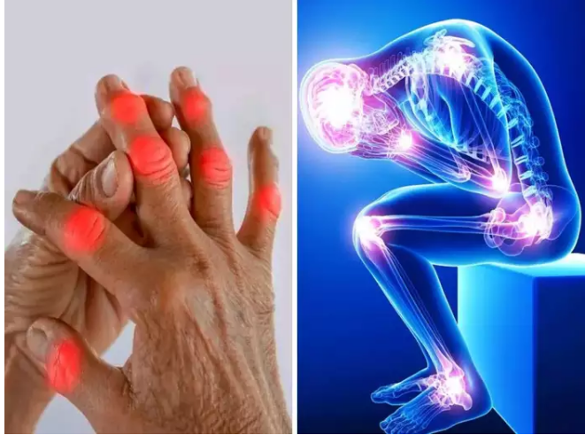 التهاب المفاصل