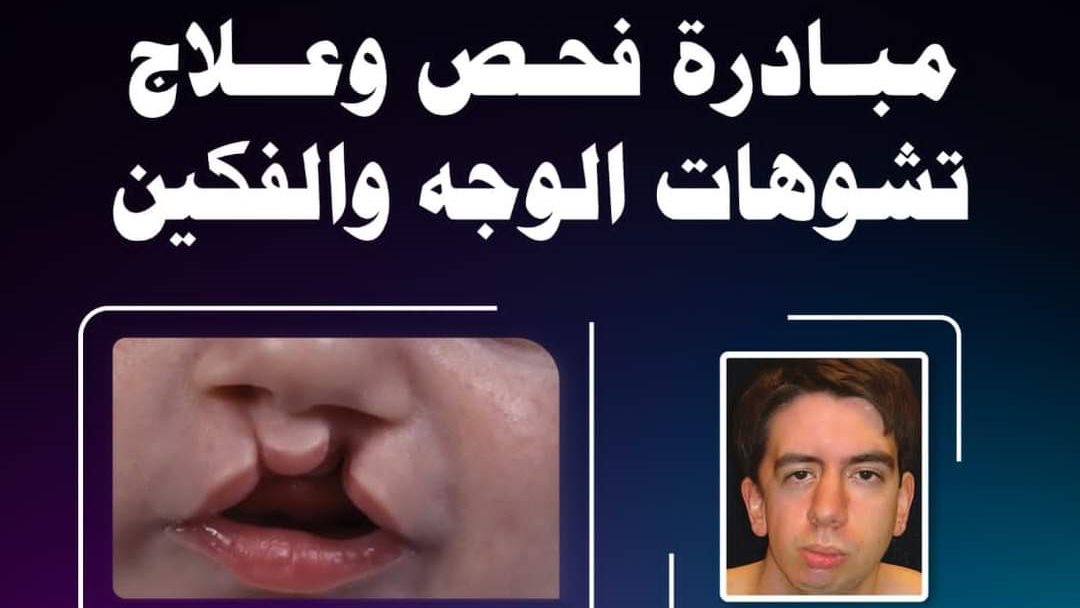 مبادرة علاج تشوهات الوجه والفكين 