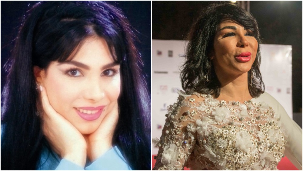 أولهن حورية فرغلي.. شاهد| فنانات عانين بسبب عمليات التجميل
