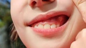 خراج الضرس