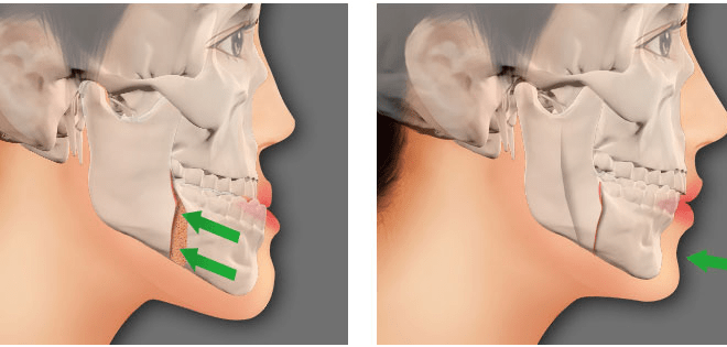 رسم توضيحي لكسر الفك