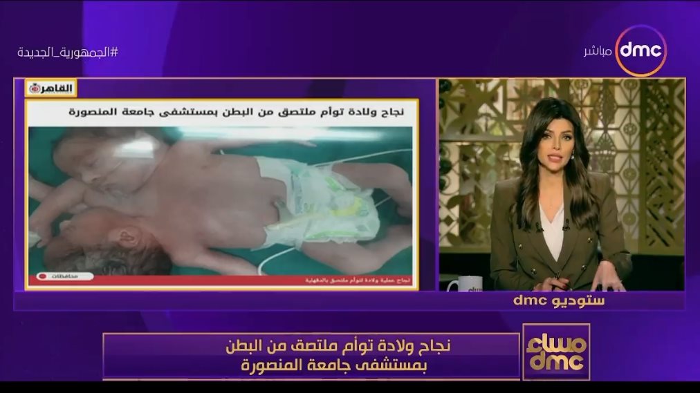 تؤام ملتصق البطن 